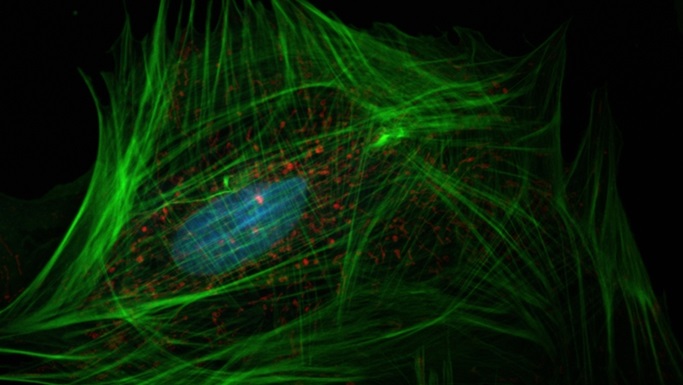 卵巢癌：疾病快速传播的步骤