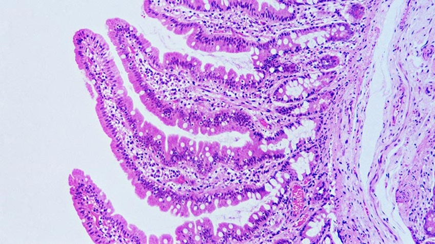 潜在新疗法修复炎症性肠病的肠屏障