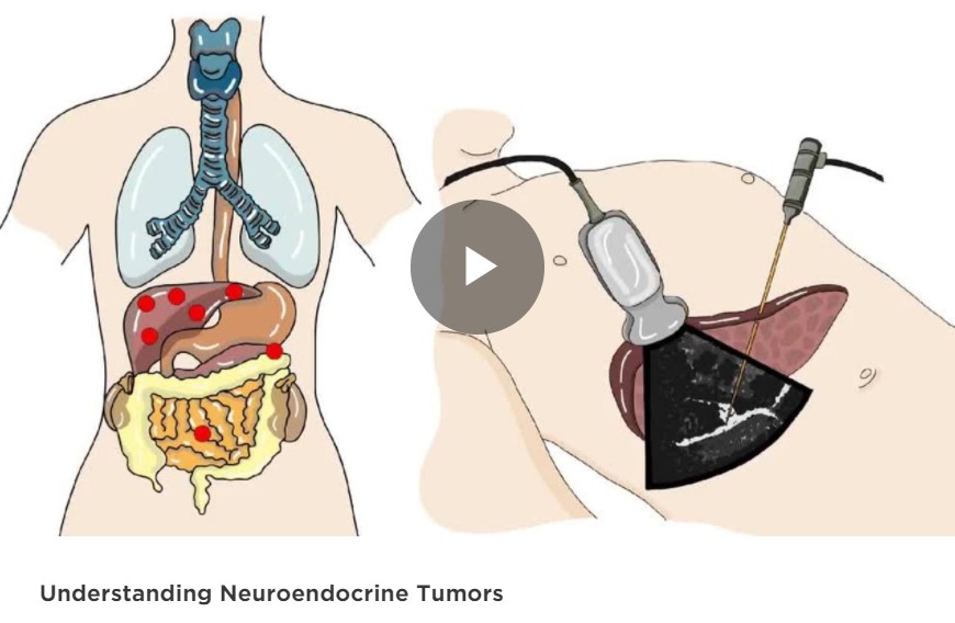 胰腺神经内分泌肿瘤的研究进展